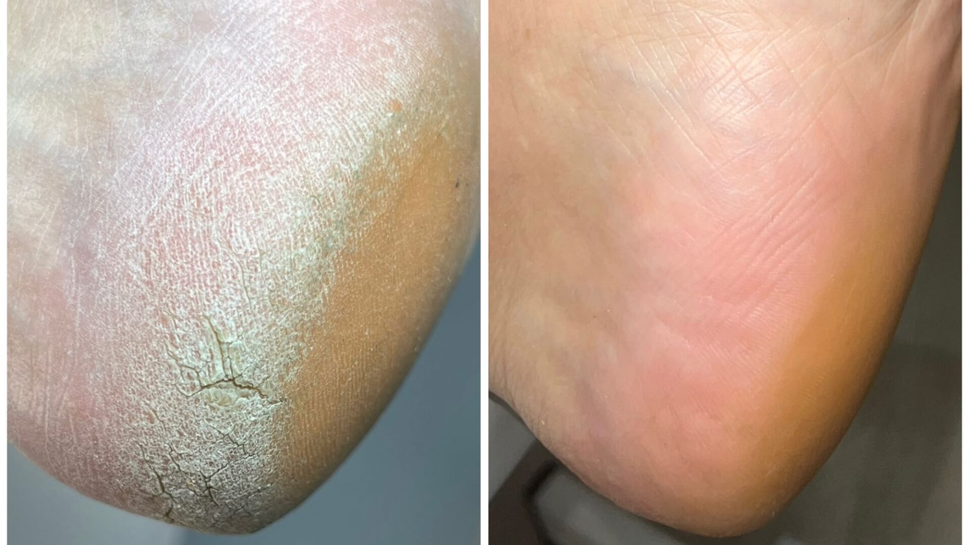 תמי דה לאון-פדיקור קוסמטי 